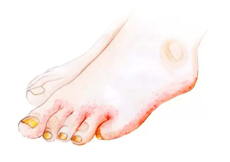 Fungus on the toes and how to apply Zenidol cream