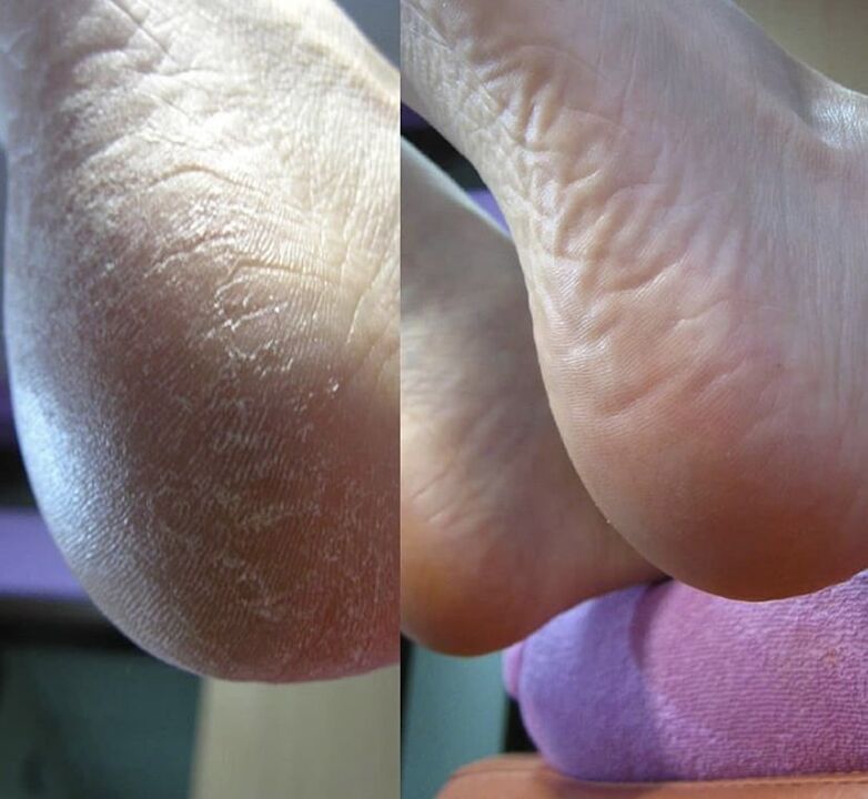 Photo of the heel before and after using Zenidol cream