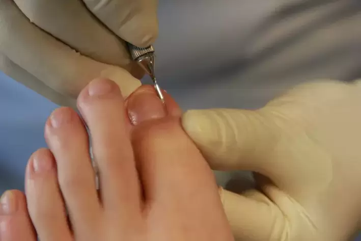 fungal infection during a pedicure