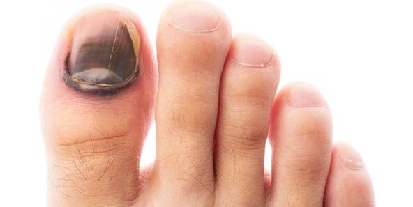 black nail as a symptom of a mold