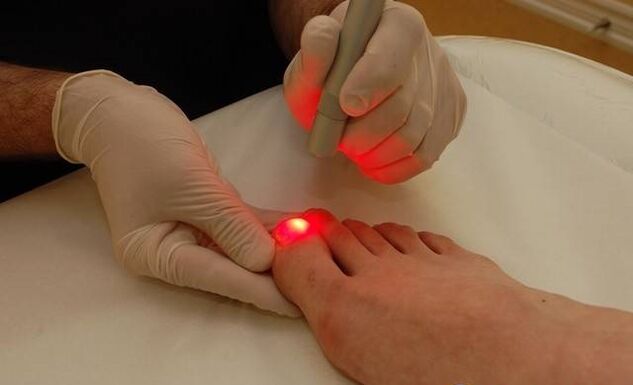 laser treatment for toenail fungus