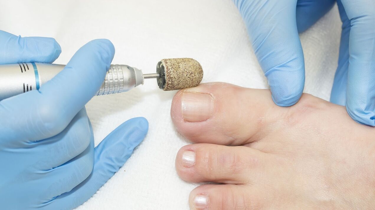 hardware treatment of fungi on toenails