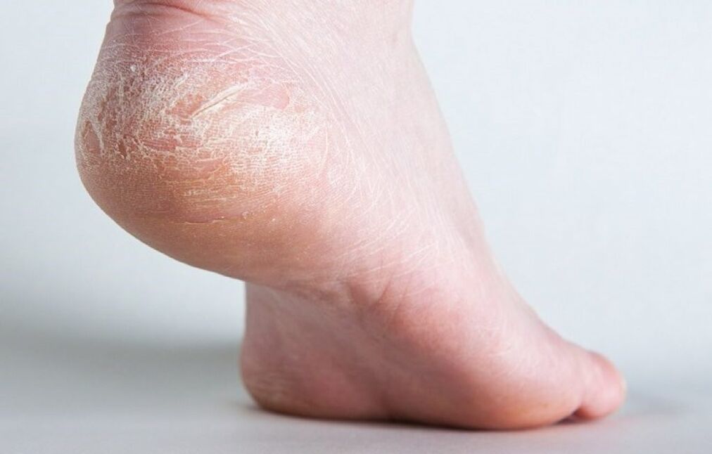 fungus on the skin of the feet how to treat