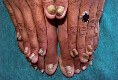 fungus on fingernails and toenails
