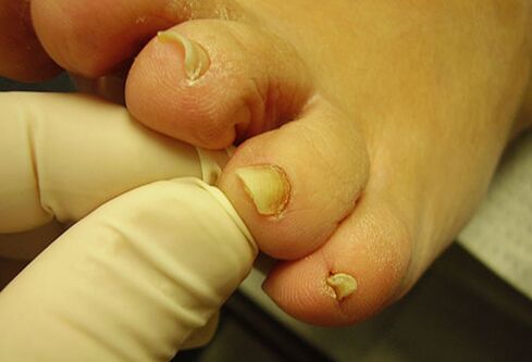 yellow toenail fungus