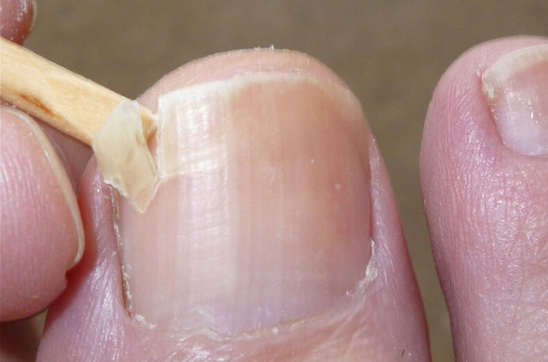 Damaged nails are a risk factor for fungal infection