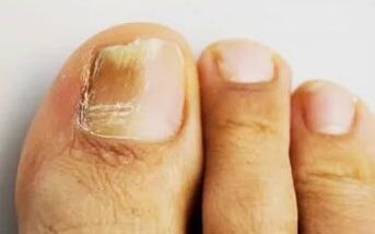 Nails affected by fungus