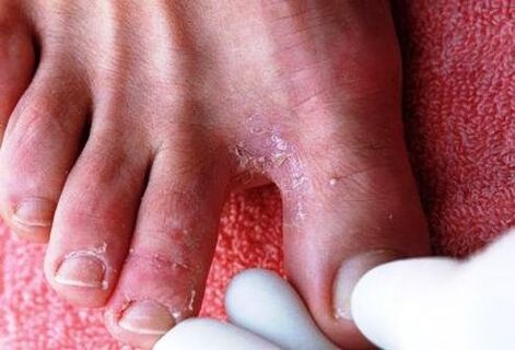 fungus between toes