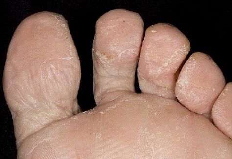 The initial phase of the fungus, between the fingers