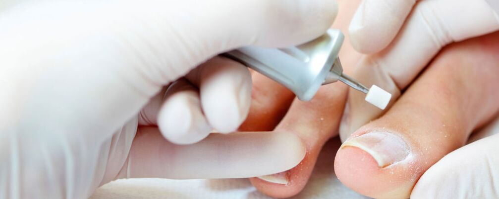 Cutting the upper layer of nail