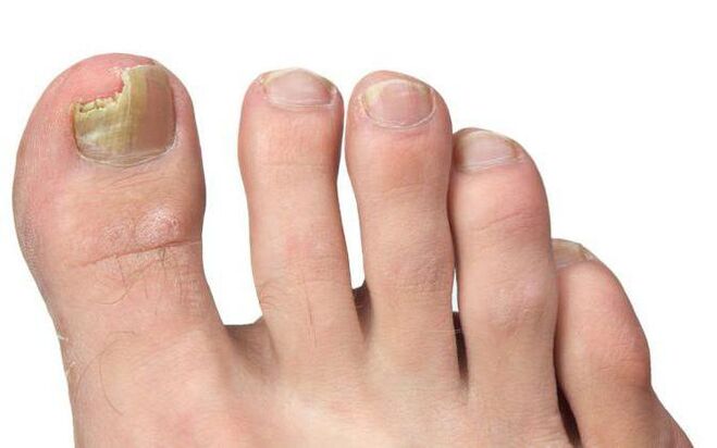 Mushrooms on the big toe