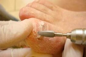 Mechanical cutting of nail plate