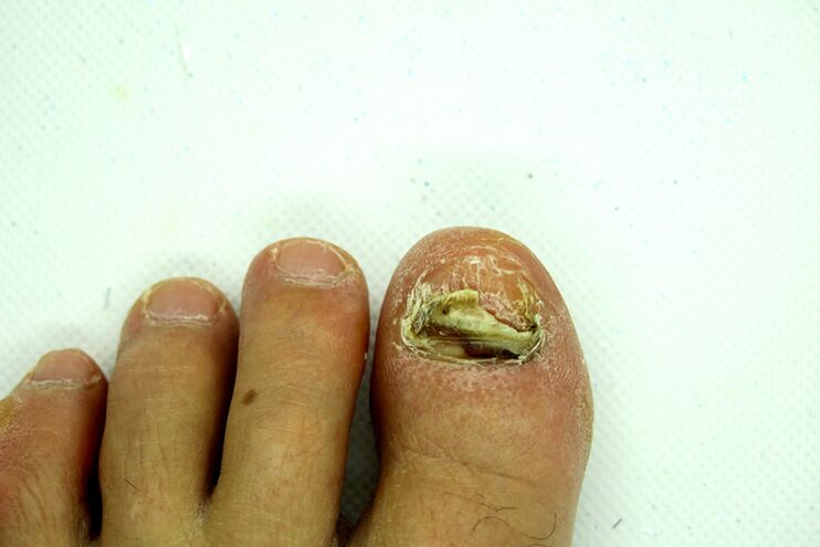 Finger nail fungus - heavy stage