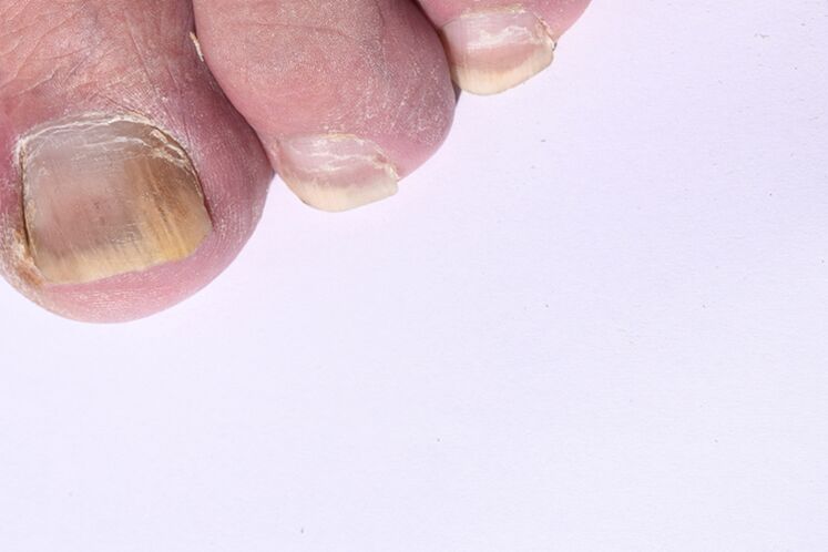 Initial phase of nail mycosis in the legs