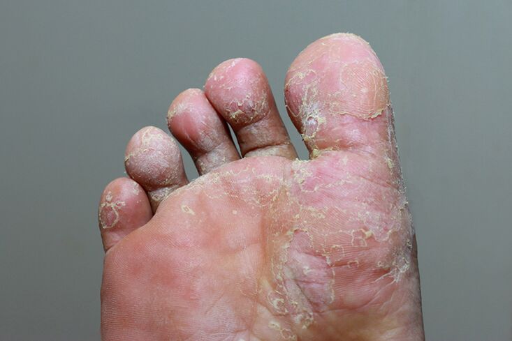 Severe phase of finger skin mycosis