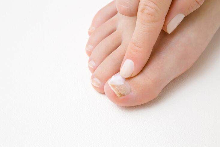 Treating the finger with oily from the fungus