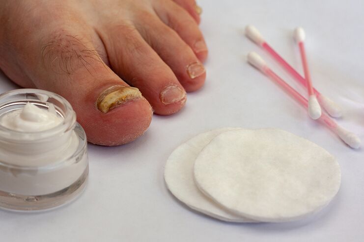 Treatment of fungi fungi with cream from fungi