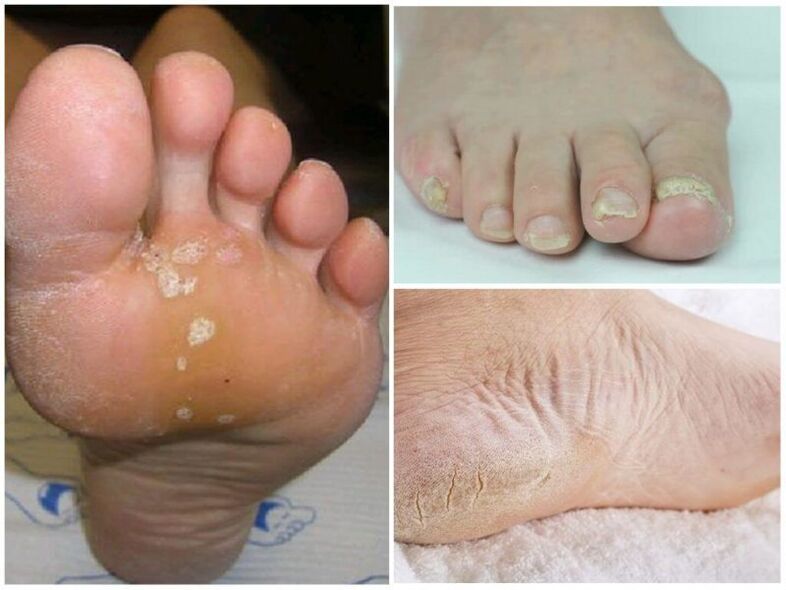 The symptoms of mycosis