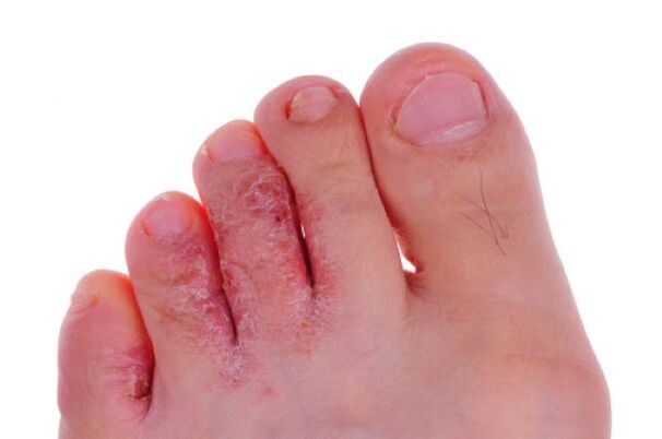 fungal disease of the fingers