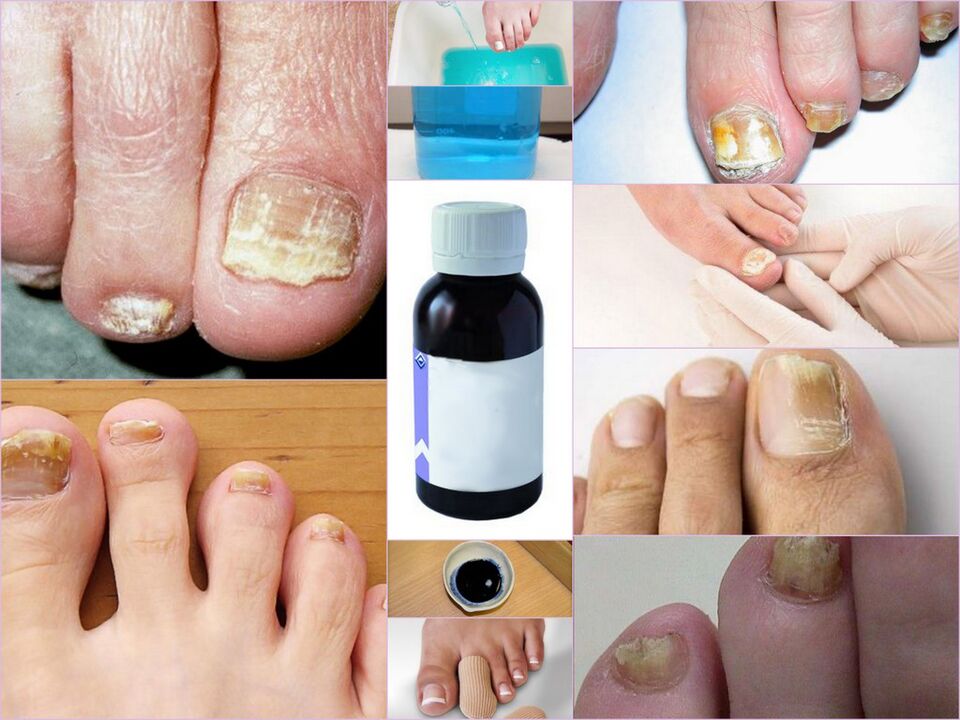 nail fungus remedies