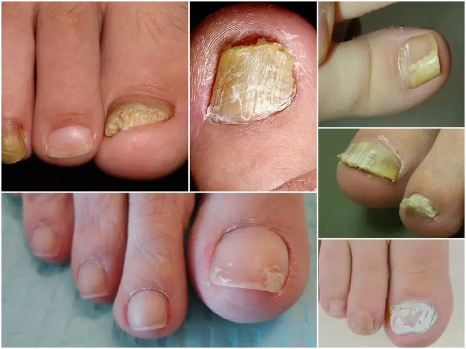 The appearance of different forms of onychomycosis