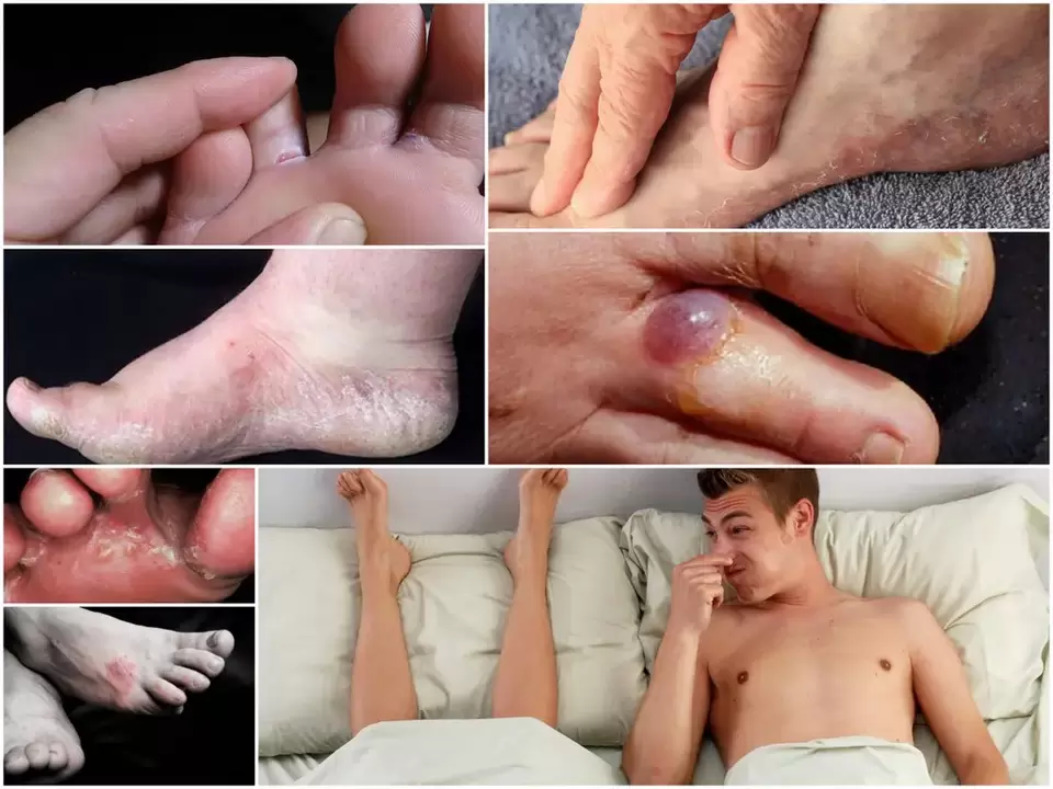 The main signs of foot fungus