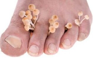 Onychomycosis of toenails