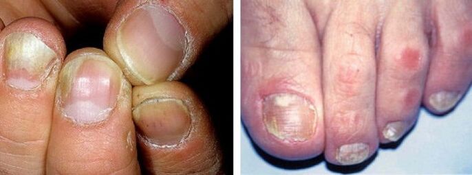 manifestations of a fungal infection on the nails
