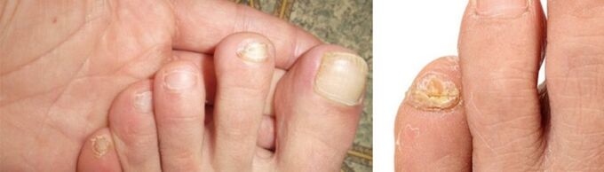 picture of manifestations of fungus on toenails