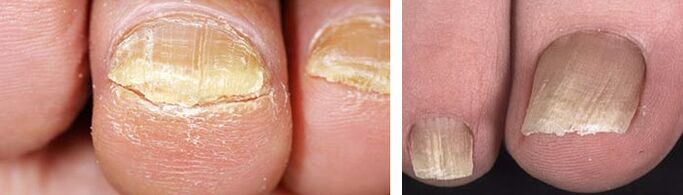 nail damage with a fungal infection