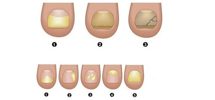stages and symptoms of toenail fungus