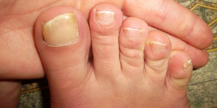 fungal toenail damage
