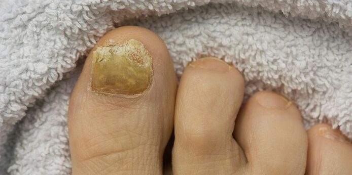 yellow toenails with fungal infection