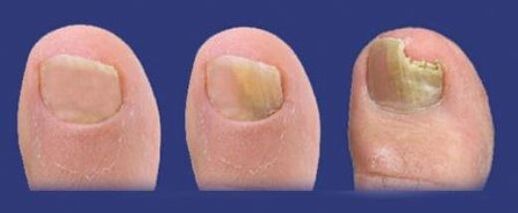 stages of fungal development in toenails