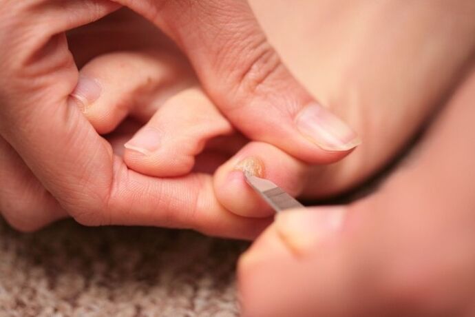 Antifungal treatment of nails