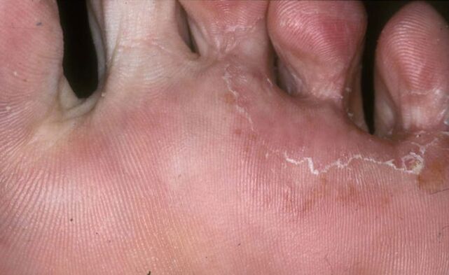 foot affected by the fungus trichophyton rubrum