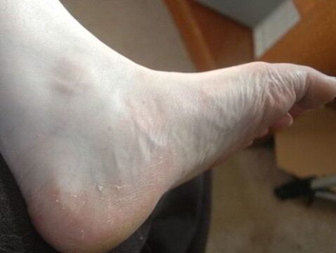 heel spurs of the foot as a sign of fungal infection