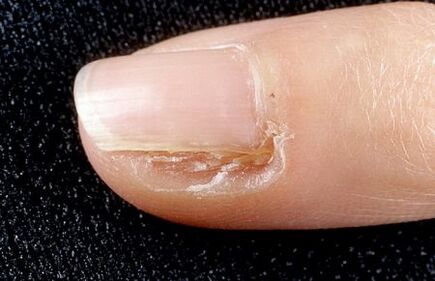 removing a portion of the nail with the fungus