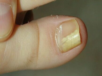 subungual nail fungus
