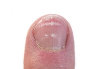 the initial stage of nail fungus infection