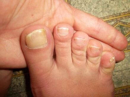 toenail affected by the fungus
